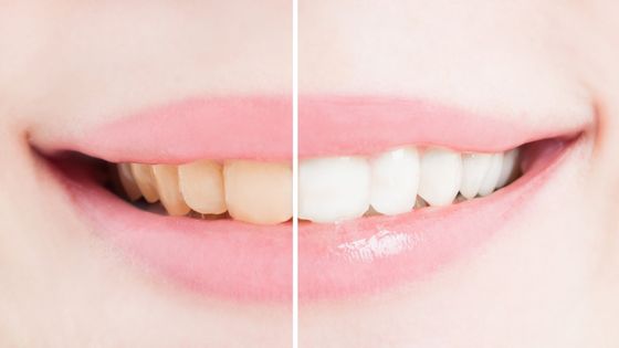 What You Need to Know About Professional Teeth Whitening